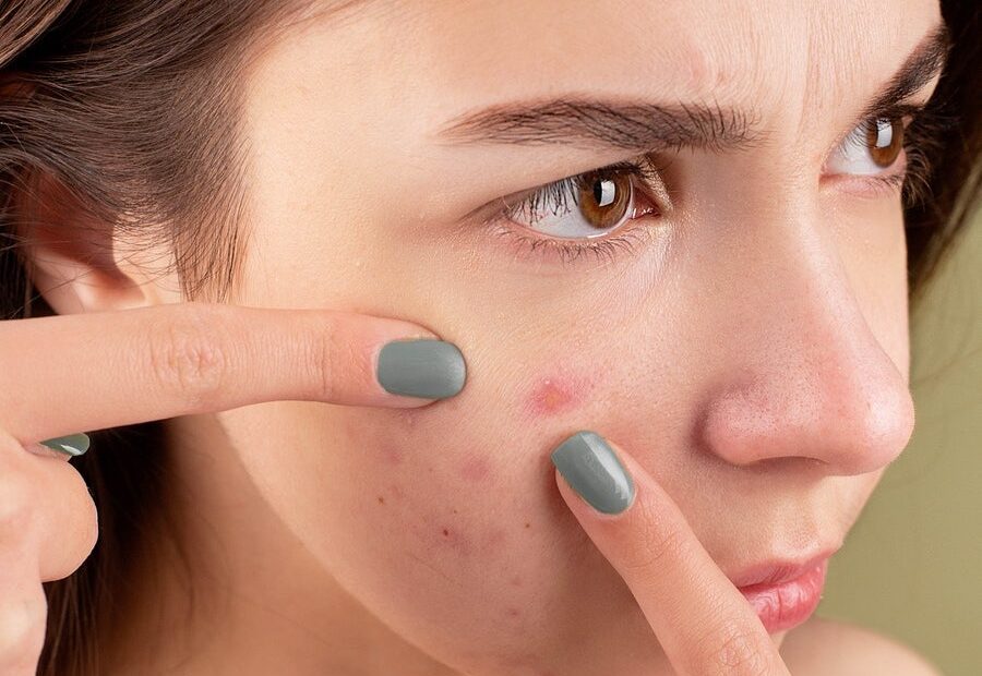 What is acne and why does it affect woman of all ages